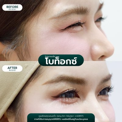 รีวิวโบลดริ้วรอย