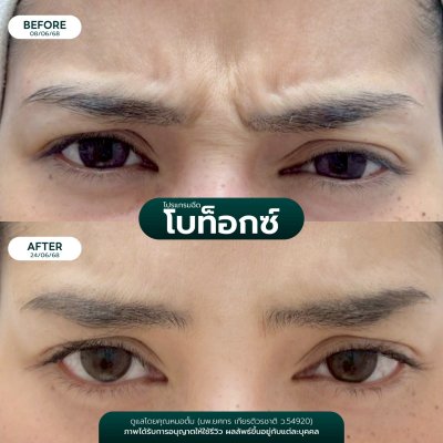 รีวิวโบลดริ้วรอย