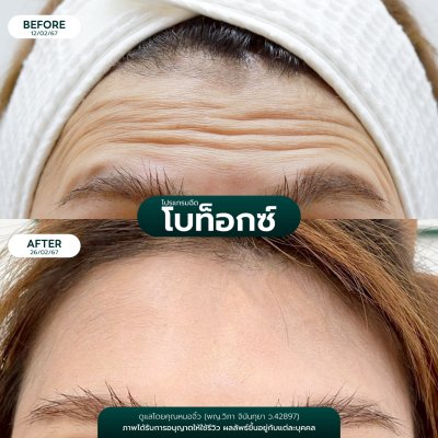 รีวิวโบลดริ้วรอย
