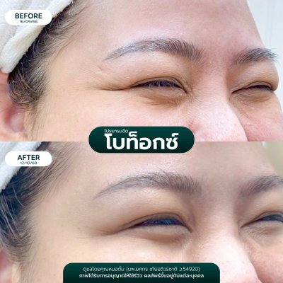 รีวิวโบลดริ้วรอย