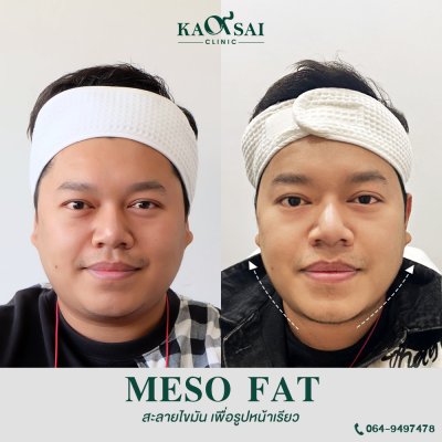 Meso Fat