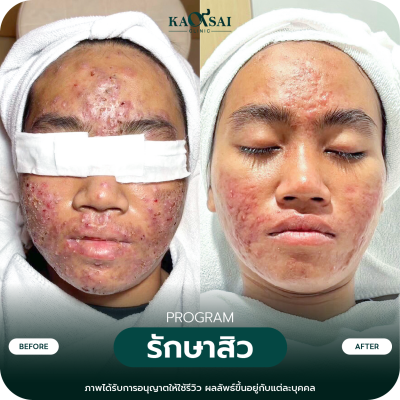 รีวิว รักษาสิว