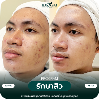 รีวิว รักษาสิว