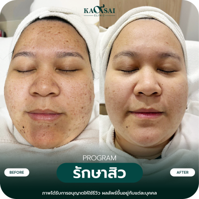 รีวิว รักษาสิว