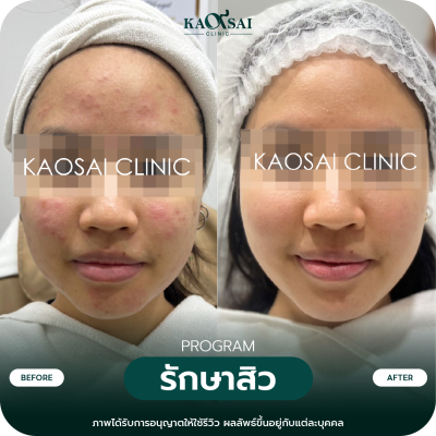 รีวิว รักษาสิว