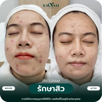 รีวิว รักษาสิว
