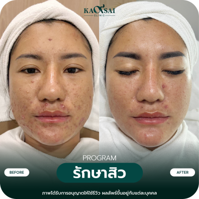 รีวิว รักษาสิว