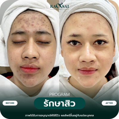 รีวิว รักษาสิว