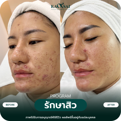 รีวิว รักษาสิว