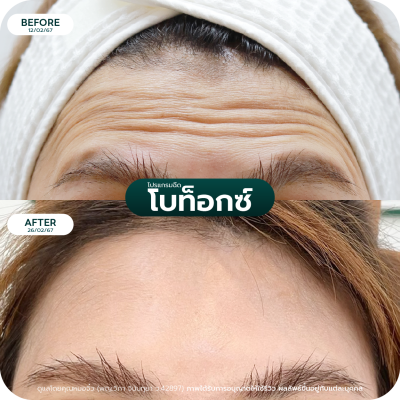 รีวิว Botox