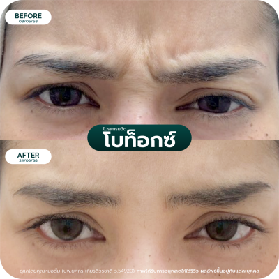 รีวิว Botox