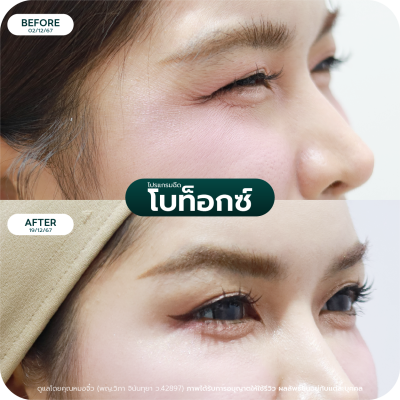 รีวิว Botox