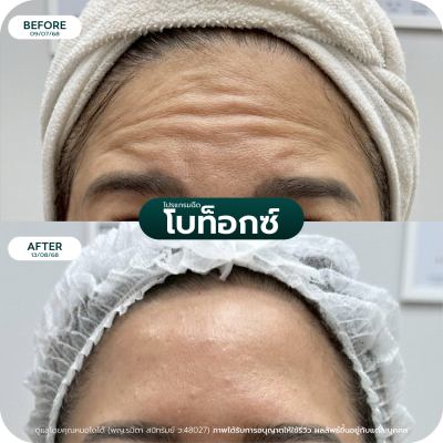 รีวิว Botox