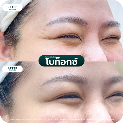 รีวิว Botox