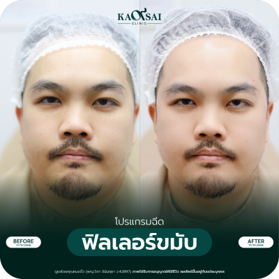 รีวิว Filler ขมับ