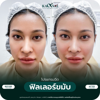 รีวิว Filler ขมับ