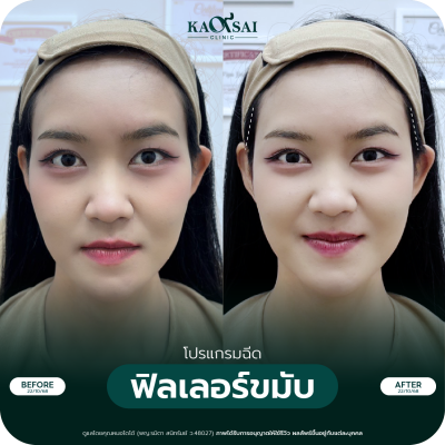 รีวิว Filler ขมับ