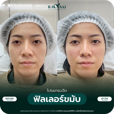 รีวิว Filler ขมับ