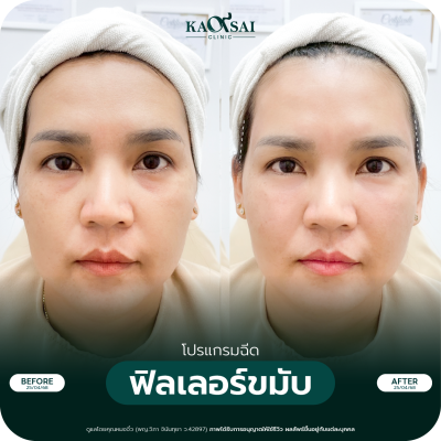 รีวิว Filler ขมับ