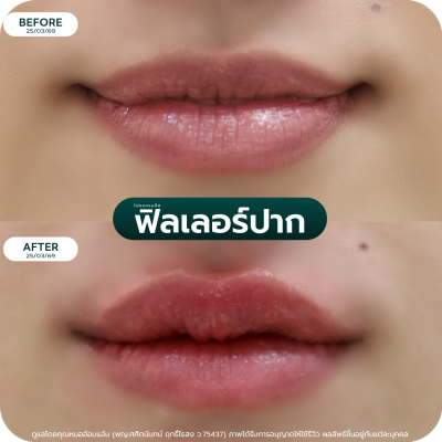 รีวิว Filler ปาก