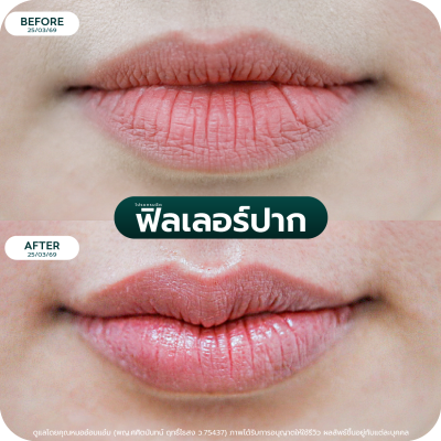 รีวิว Filler ปาก