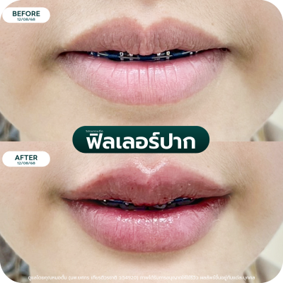 รีวิว Filler ปาก