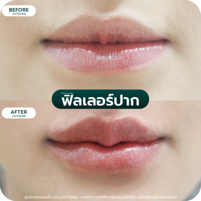 รีวิว Filler ปาก