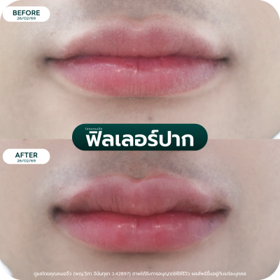 รีวิว Filler ปาก