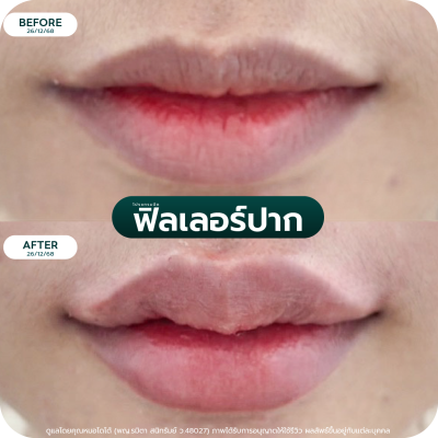 รีวิว Filler ปาก