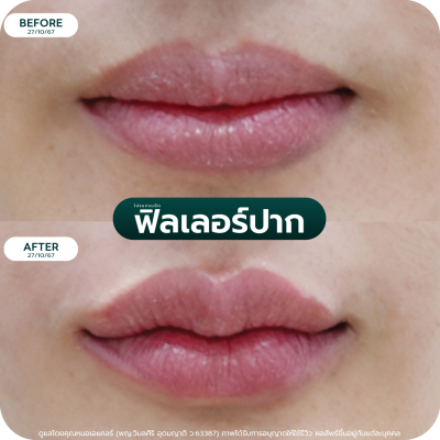 รีวิว Filler ปาก