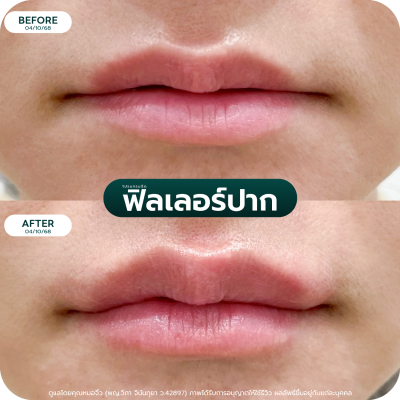 รีวิว Filler ปาก