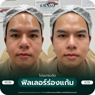 รีวิว Filler ร่องแก้ม