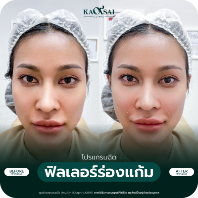 รีวิว Filler ร่องแก้ม