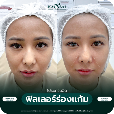 รีวิว Filler ร่องแก้ม