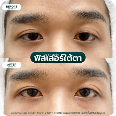 รีวิว Filler ใต้ตา