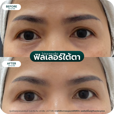 รีวิว Filler ใต้ตา