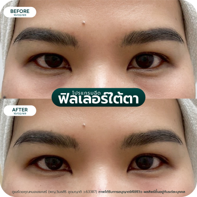 รีวิว Filler ใต้ตา