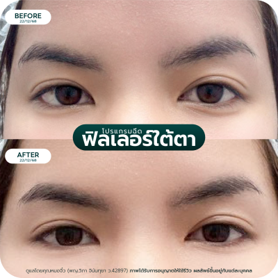 รีวิว Filler ใต้ตา