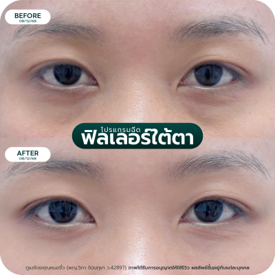 รีวิว Filler ใต้ตา
