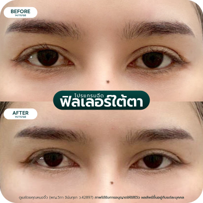 รีวิว Filler ใต้ตา