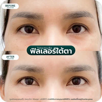 รีวิว Filler ใต้ตา