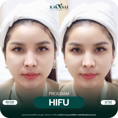 Hifu