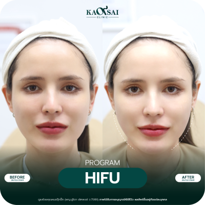 Hifu