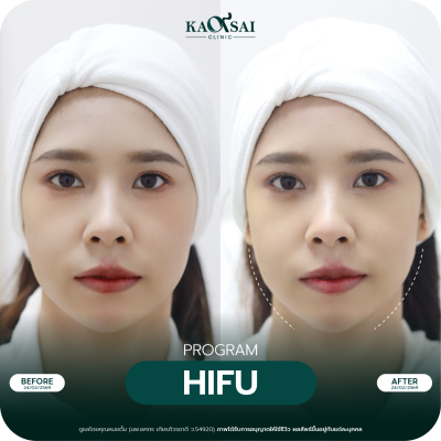 Hifu