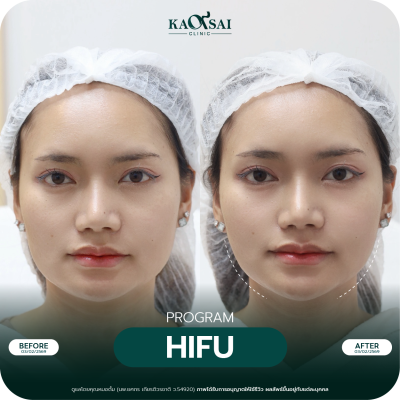 Hifu