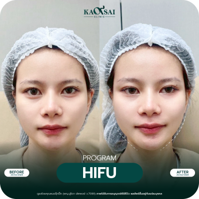 Hifu