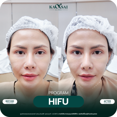 Hifu