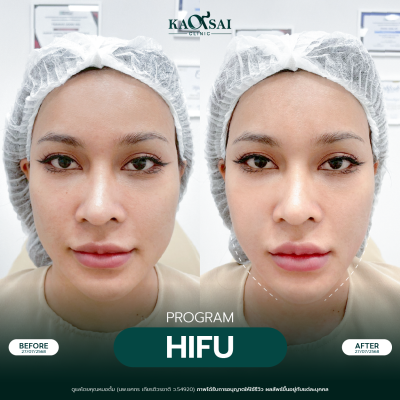 Hifu