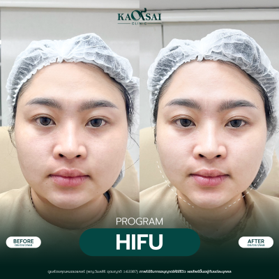 Hifu