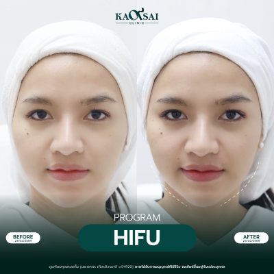 Hifu